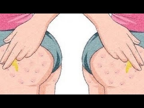 لايف ستايلوصفة رائعة للتخلص من حبوب المؤخرة والارداف45704/0