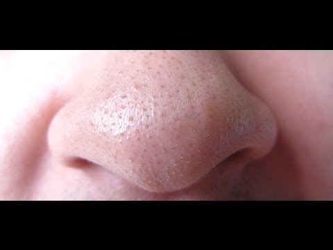 لايف ستايلشاهد: الوصفة المعجزة لإزالة الرؤوس السوداء بمكونات موجودة يوميا بمطبخك45707/0