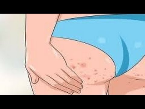 لايف ستايلمسحة من هذا الخليط تخلصك من حبوب المؤخرة و الارداف نهائيا49241/0