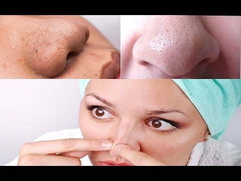 لايف ستايلتخلصي من الرؤوس السوداء والبيضاء نهائيًا50113/0