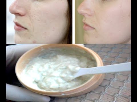 لايف ستايلشاهد: ماسك سهل وسريع لعلاج أثار الحبوب من البشرة51058/0