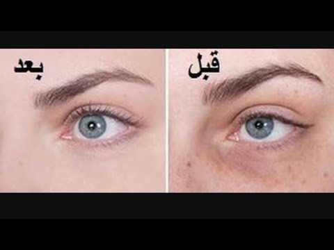 لايف ستايلشاهد: التخلص من الهالات السوداء والانتفاخ تحت العين51068/0