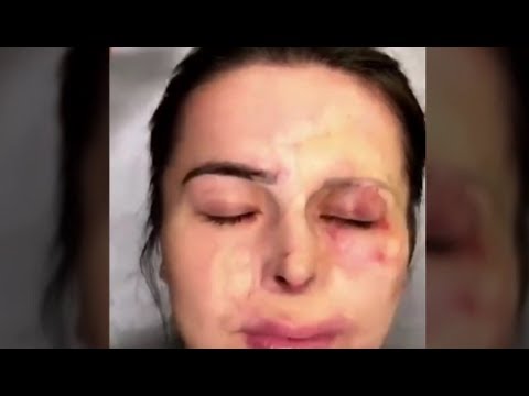 لايف ستايلبالفيديو : الماكياج يغير ملامح فتاة وجهها محروق51791/0
