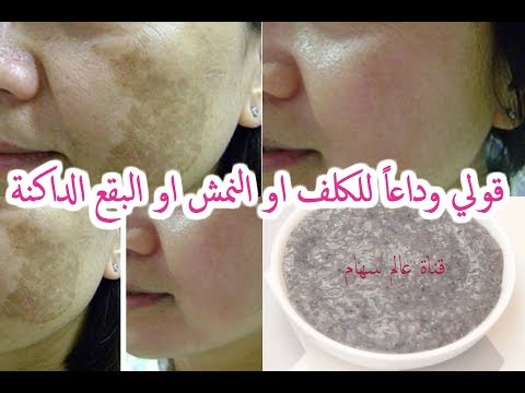لايف ستايلبالفيديو: مكونات تخلصك من الكلف أو النمش أو البقع الداكنة52093/0