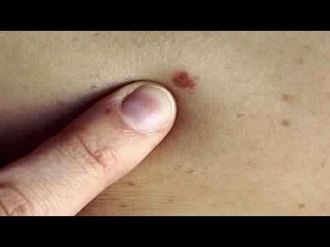 لايف ستايلتعرف على ما هي أعراض السرطان المبكرة52401/0