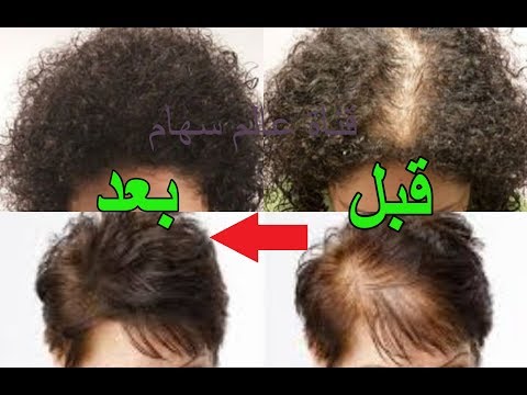 لايف ستايلتخلصي من فراغات فروة الرأس شعرك خلال ساعتين55367/0