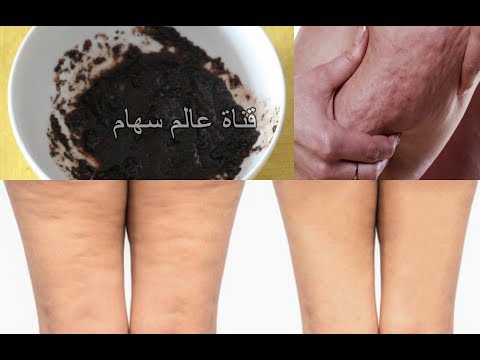 لايف ستايلتخلصي من السيلوليت و الخطوط البيضاء نهائيًا في 5 دقائق55368/0