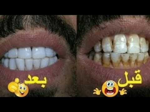 لايف ستايلشاهد: خلطة سهلة للحصول على أسنان بيضاء56264/0