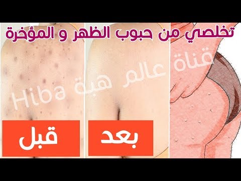 لايف ستايلوصفة ستخلصك من حبوب الظهر والصدر والمؤخرة56748/0
