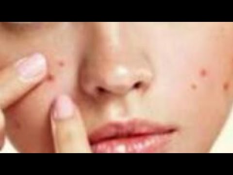 لايف ستايلعلاج حبوب الوجة في خمس دقائق57722/0