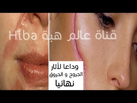 لايف ستايلوصفات لازالة آثار الجروح و الحروق والندبات نهائيًا58573/0