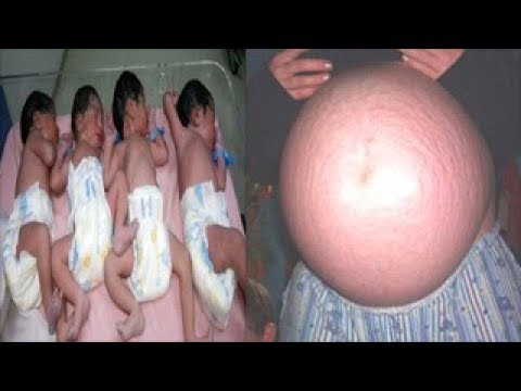 لايف ستايلإمرأة تلد 4 أطفال توأم ولكن بهم شئ غريب59658/0