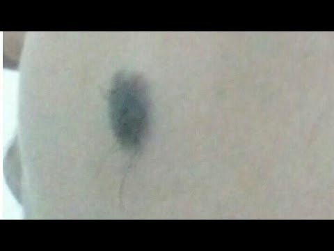 لايف ستايلوصفة لإزالة الشامة التخلص من الحسنة في الوجه والجسم60208/0