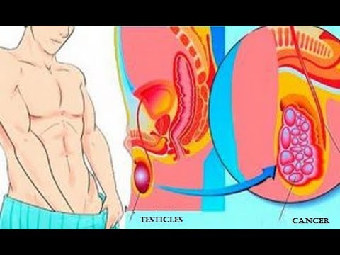 لايف ستايلبالفيديو : احذر قد يكون لديك سرطان الخصية ..60749/0