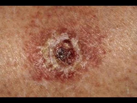 لايف ستايلشاهد: 5 علامات تُنذرك مبكرًا بسرطان الجلد61044/0