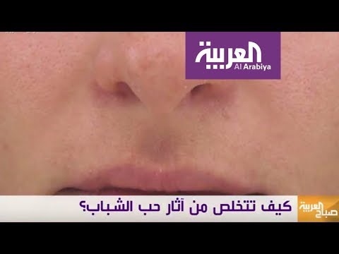 لايف ستايلشاهد| طرق فعالة ومختلفة لعلاج ندبات حب الشباب62324/0