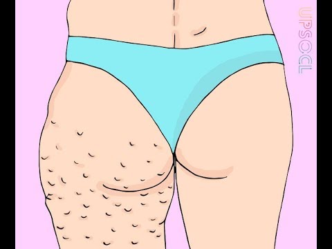 لايف ستايلشاهد: أسباب وطريقة علاج مرض السيلوليت الجلدي 63185/0