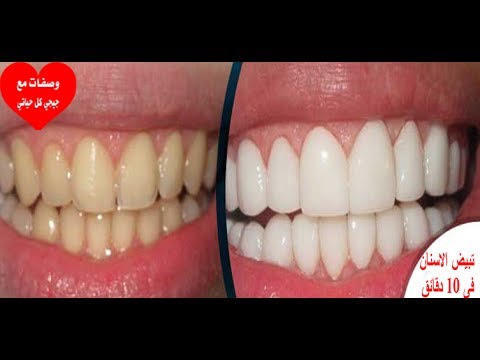 لايف ستايلتبيض الأسنان خلال 10 دقائق فقط63297/0
