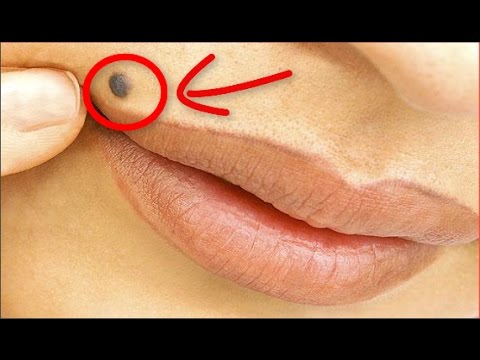 لايف ستايلشاهد: أسباب وجود الشامات على جسم الإنسان ومدى خطرها على الصحة65093/0