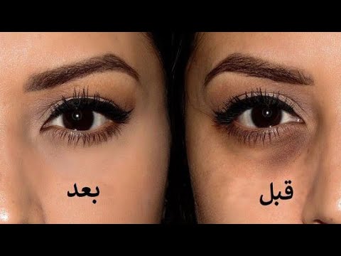 لايف ستايلشاهد: ما دلالة السواد أسفل العينين وإلى ماذا يُشير65331/0