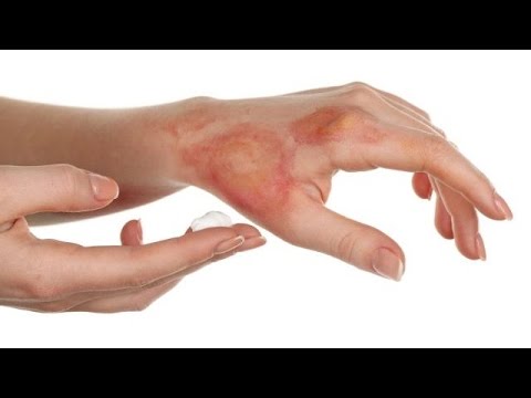 لايف ستايلتعرف على أسرع طرق لعلاج الحروق65670/0