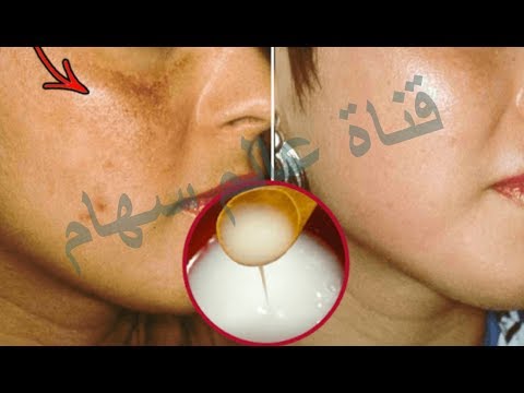 لايف ستايلشاهد: خلطة سحرية لازالة الكلف والبقع والتصبغات65746/0