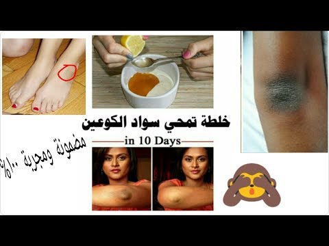 لايف ستايلشاهد: خلطة ( تبييض ) تخلصك من سواد الركب66026/0