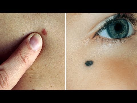 لايف ستايلشاهد: هل تعلم ماذا يعني وجود هذه الشامات على جسمك66937/0