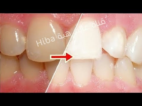 لايف ستايلالوصفة المعجزة لتبييض الأسنان خلال دقيقة واحدة67735/0