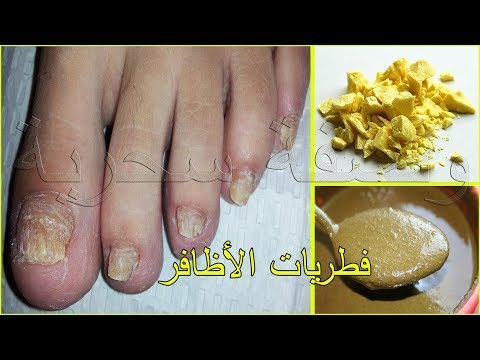 لايف ستايلطريقة التخلص من فطريات الأظافر والأكزيما67783/0