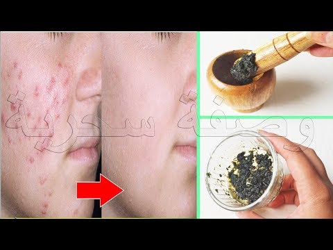 لايف ستايلشاهد: الحل النهائي والسريع لحب الشباب67784/0