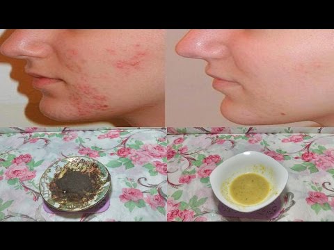 لايف ستايلالحل النهائي للتخلّص من حب الشباب67937/0