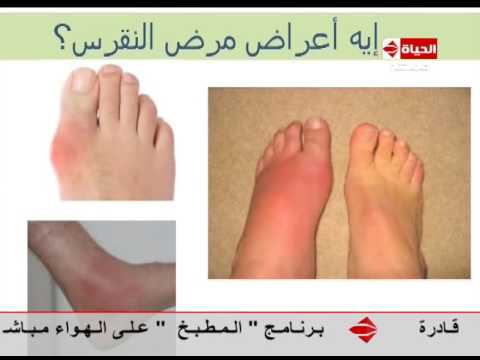 لايف ستايلتعرف على ما هي أعراض مرض النقرس14046/0