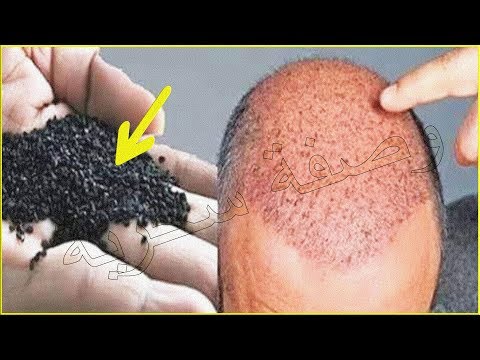 لايف ستايلشاهد: وصفة تنبت الشعر وتملأ الفراغات من أول استعمال68509/0