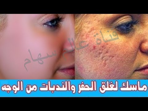 لايف ستايلالحل الوحيد والنهائي للتخلص من المسامات الواسعة68670/0