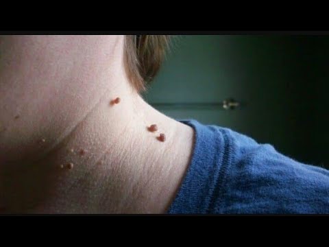 لايف ستايلشاهد: وصفة سحرية للقضاء على "التالول" أو "الثالول" والزوائد الجلدية69730/0