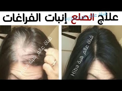 لايف ستايلتعرّف على أقوى وصفة لمنع تساقط الشعر71299/0