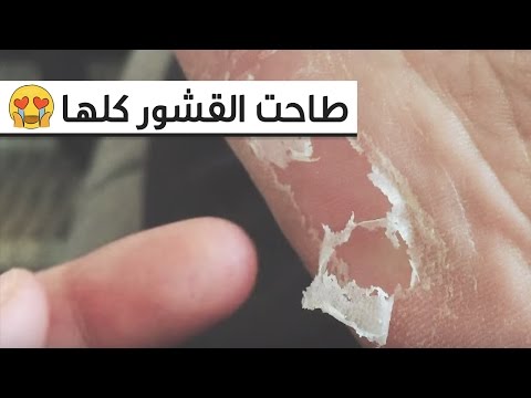 لايف ستايلعلاج تشققات وخشونة القدمين73303/0