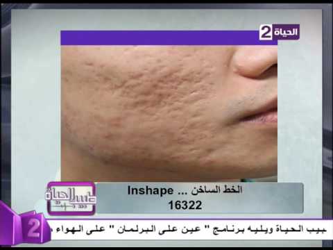 لايف ستايلشاهد: الدكتور يحيى حشيش يوضح أهمية استخدام الليزر14581/0