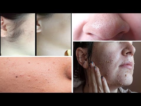 لايف ستايلشاهد: وصفة مركبة لإزالة الشعر من الوجه و الرؤوس السوداء والبيضاء75377/0
