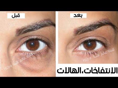 لايف ستايلأسرع طريقة للتخلّص من الهالات السوداء75511/0