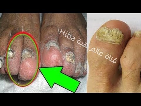 لايف ستايلشاهد: أسرع وأرخص علاج لفطريات القدمين وفطريات الأظافر75526/0