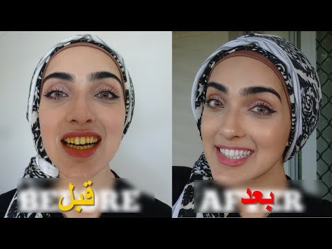 لايف ستايلشاهد: تبييض الأسنان الصفراء بشكل طبيعي خلال دقائق76222/0