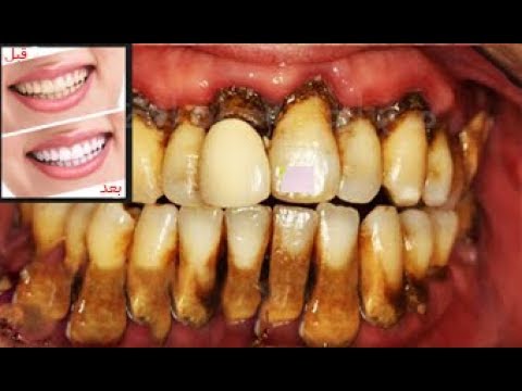 لايف ستايلبالفيديو: كيفيه تبييض الأسنان بطريقة طبيعية صحية76977/0