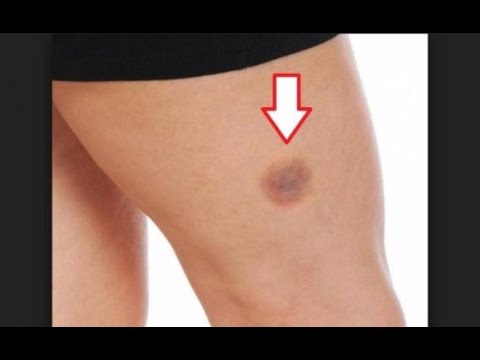 لايف ستايلبالفيديو : أسباب ظهور كدمات على الجسم عند الاستيقاظ76983/0