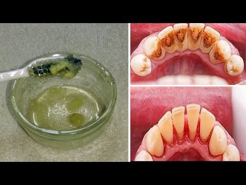 لايف ستايلوصفة لإزالة جير الأسنان في 5 دقائق77153/0