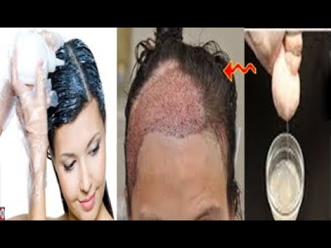 لايف ستايلخلطة لعلاج شيب الشعر نهائيًا دون صبغه وزيادة نموه78208/0