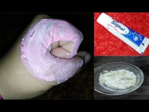 لايف ستايلشاهد: طريقة إزالة البواسير في يوم واحد دون عمليات جراحية79849/0