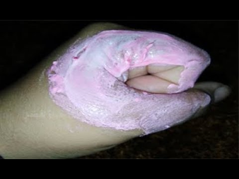 لايف ستايلشاهد: طريقة إزالة البواسير في يوم واحد دون عمليات جراحية79861/0