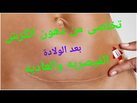 لايف ستايلبالفيديو: تخلصي من دهون البطن بعد الولادة القيصرية والعادية80395/0